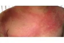 Bebek Vücudunda Kızarıklık Belirtileri ve Tedavisi Bebek Vücudunda Kızarıklık Belirtileri ve Tedavisi