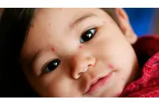 Bebeklerde Ateş Sonrası Vücutta Kızarıklık Bebeklerde Ateş Sonrası Vücutta Kızarıklık