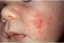Bebeklerde Kızarıklık Nedenleri Bebeklerde Kızarıklık Nedenleri