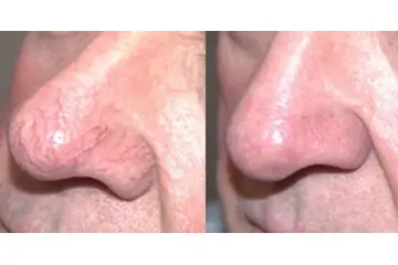 Burun Üstünde Kızarıklık Belirtileri ve Tedavisi