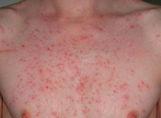 Göğüste Kızarıklık Nedenleri?