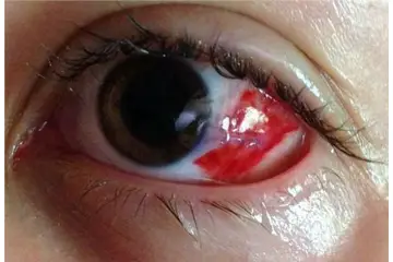 Göz Kızarıklığına Ne İyi Gelir?