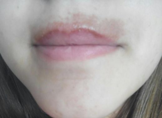 Ağda Sonrası Kızarıklık Nedenleri