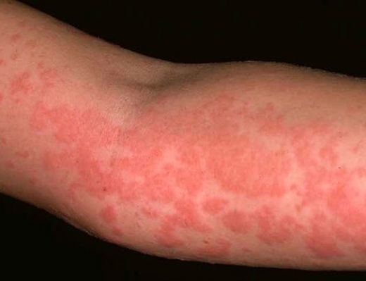 Alerjik Kızarıklıklar Belirtileri ve Tedavisi