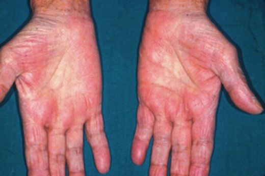 Avuç İçinde Kızarıklık Nedenleri?