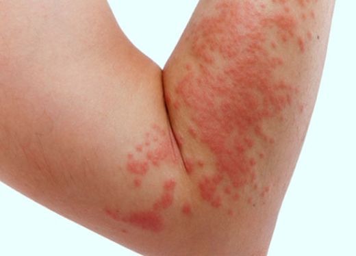 Bacaklarda Kaşıntı ve Kızarıklık Belirtileri ve Tedavisi