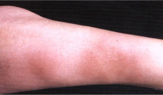 Bacakta Kızarıklık ve Şişlik Belirtileri ve Tedavisi