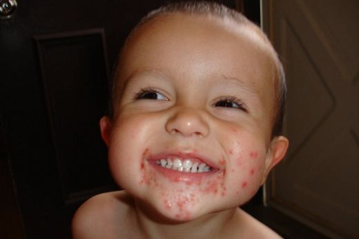 Bebeklerde Ağız Çevresinde Kızarıklık