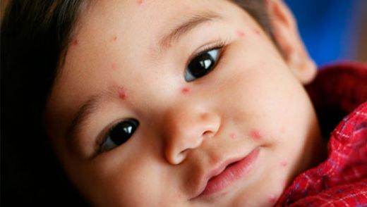 Bebeklerde Ateş Sonrası Vücutta Kızarıklık