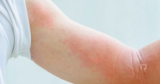 Bebeklerde Kollarda Kızarıklık Nedenleri