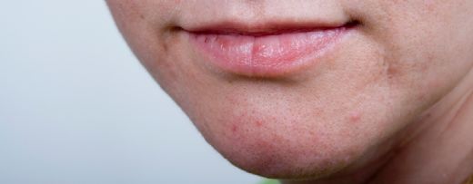 Çenede Kızarıklık Nedenleri