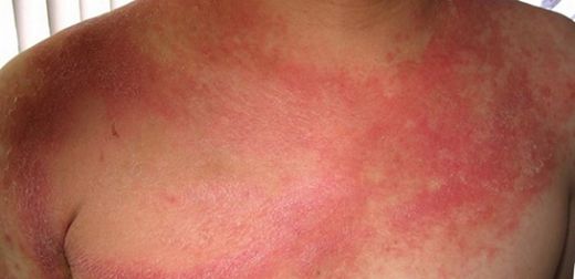 Ciltte Kızarıklık Nasıl Tedavi Edilir?