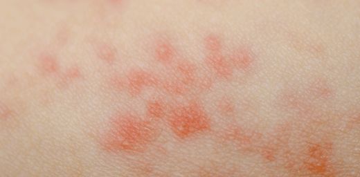 Ciltte Kızarıklık Kaşıntı Belirtileri ve Tedavisi