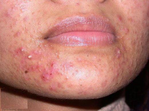 Ciltte Kızarıklık ve Kabarma Nasıl Gelişir