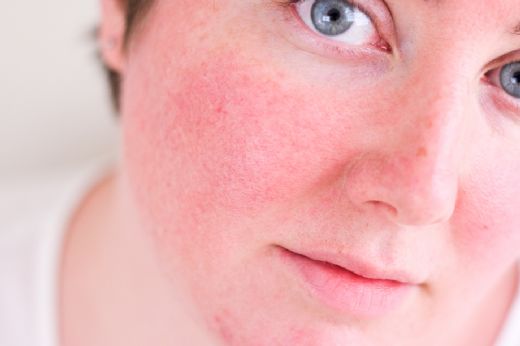 Ciltte Kızarıklık ve Yanma Sebepleri