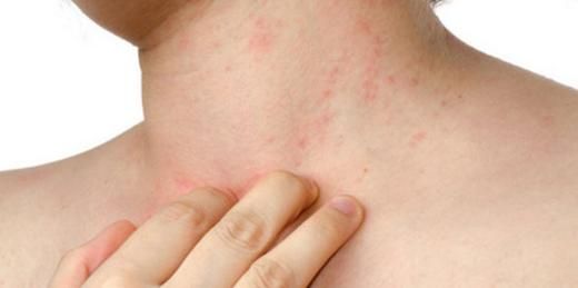 Deride Kaşıntı ve Kızarıklık Belirtileri ve Tedavisi