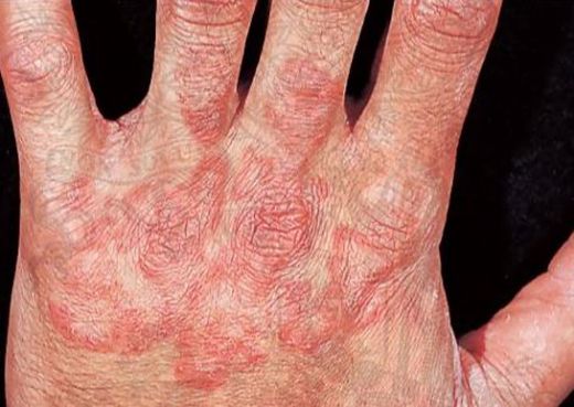 El Üstünde Kızarıklık Nedenleri