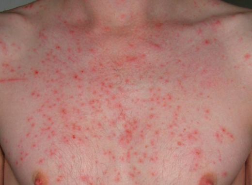 Göğüste Kızarıklık Nedenleri?