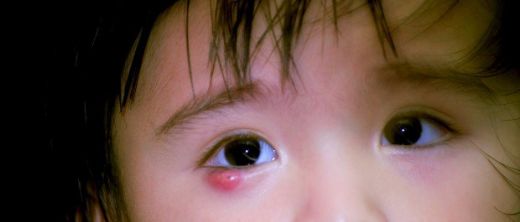 Göz Çevresinde Kızarıklık Nasıl Geçer