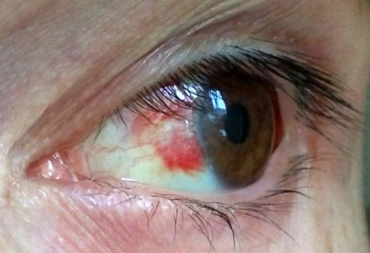 Göz İçinde Kızarıklık Nedenleri