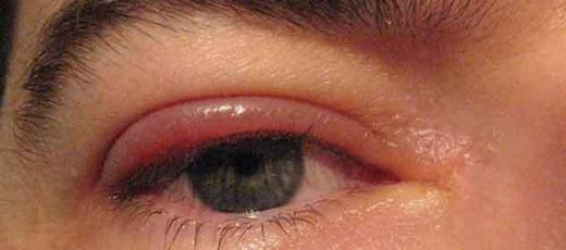 Göz Kapağında Kızarıklık Belirtileri ve Tedavisi