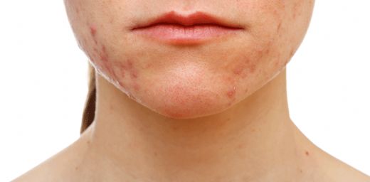 Hamilelikte Yüzde Kızarıklık Nedenleri?