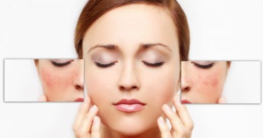 Kızarıklık Nasıl Geçer?