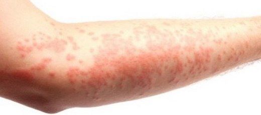 Stresten Vücutta Çıkan Kızarıklıklar Belirtileri ve Tedavisi