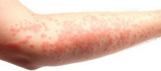 Vücutta Kızarıklık Belirtileri ve Tedavisi