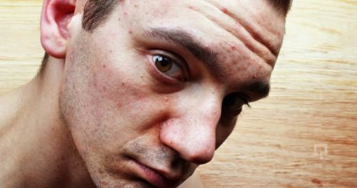 Yüzde Kızarıklık Belirtileri ve Tedavisi