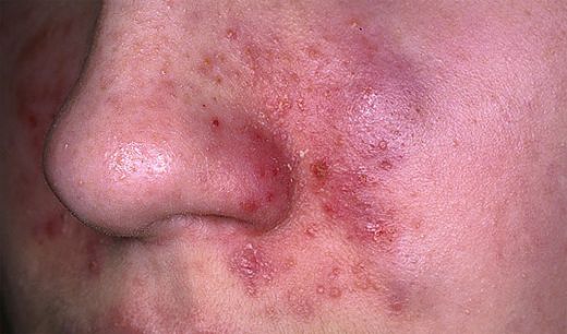 Yüzde Kızarıklık ve Pullanma Tedavisi