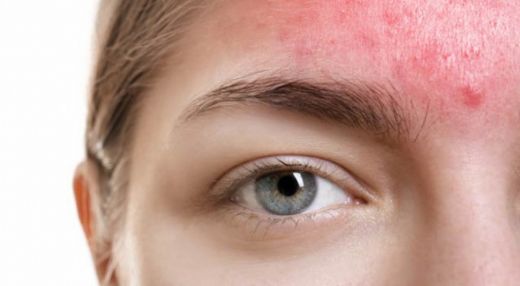Yüzdeki Kızarıklık Nasıl Geçer?