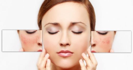 Yüzdeki Kızarıklıklar İçin Bitkisel Çözüm