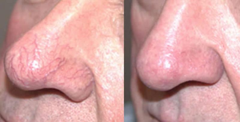 Burun Kızarıklığı Nasıl Geçer?